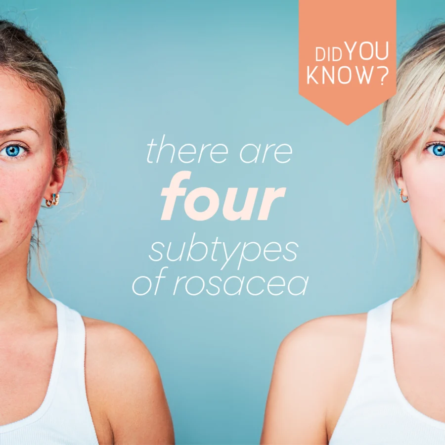 Getting to the Root of Rosacea Symptoms